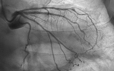 La Litotricia Intravascular en paciente con enfermedad coronaria