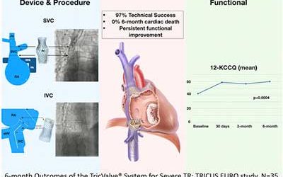 Six-Month Outcomes of the TricValve® System in Patients with Tricuspid Regurgitation: TRICUS EURO Study