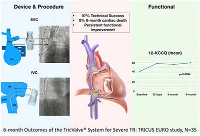 Six-Month Outcomes of the TricValve® System in Patients with Tricuspid Regurgitation: TRICUS EURO Study