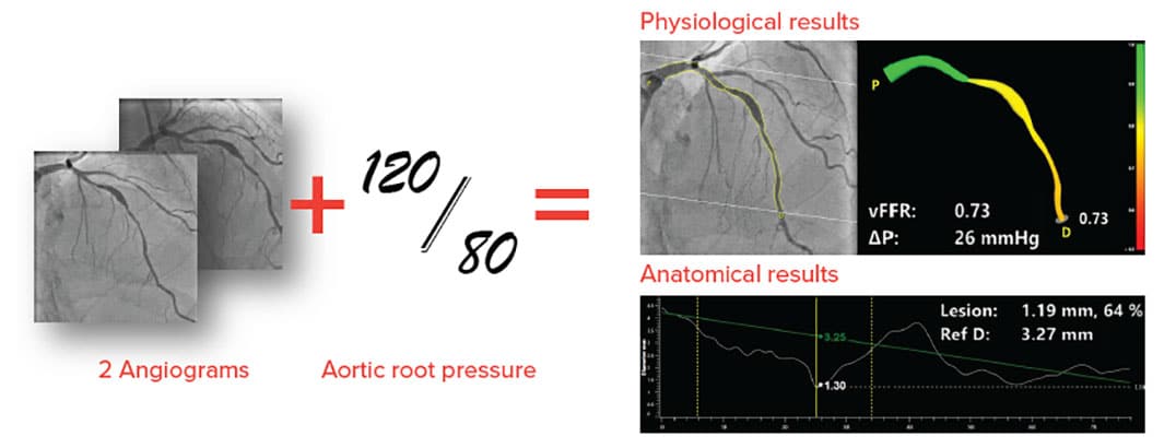 2-Angiographs-plus-aortic-root-pressure