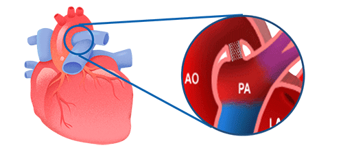 ibs-angel-indicacion La indicación del andamio biorreabsorbible de hierro lBS Angel™️ es mejorar el diámetro de la luz del conducto arterioso de recién nacidos y lactantes que requieren tratamiento con stent, con diámetros de vaso de referencia de 2,25 mm a 4,25 mm y longitud de segmento objetivo ≤ 35 mm.