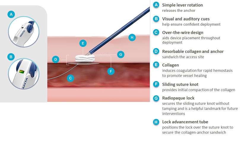 MANTA VASCULAR CLOSURE DEVICE PRODUCT FEATURES